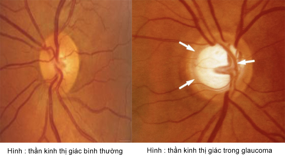Glaucoma