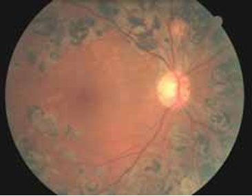 CƯỜM KHÔ KÈM BỆNH ĐÁI THÁO ĐƯỜNG VÀ TĂNG HUYẾT ÁP: CÓ NÊN PHẪU THUẬT KHÔNG?