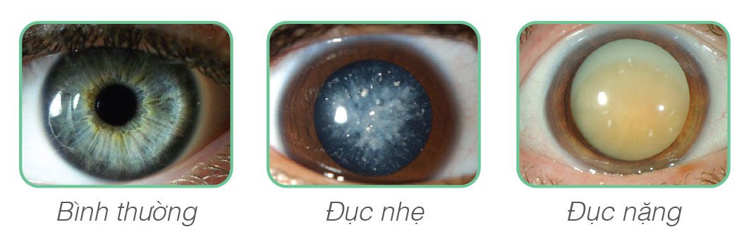 ĐỤC THỦY TINH THỂ (CƯỜM KHÔ)