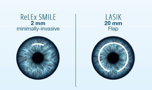 phẫu thuật smile