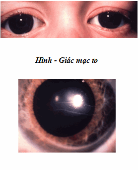 Glaucoma