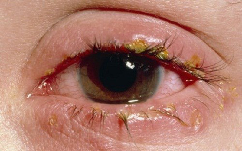 PHÂN BIỆT CÁC LOẠI VIÊM KẾT MẠC (ĐAU MẮT ĐỎ)