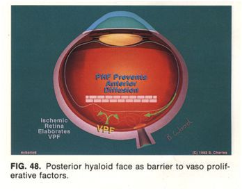 phẫu thuật cắt dịch kính