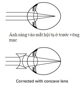 CHĂM SÓC MẮT Ở TRẺ NHỎ, TUỔI ĐI HỌC