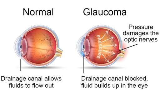 Glaucoma