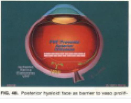 NHỮNG BIẾN CHỨNG THƯỜNG GẶP CỦA MỔ ĐỤC THỦY TINH THỂ