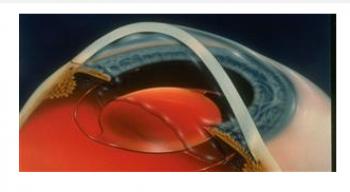 BỆNH TIỂU ĐƯỜNG KHÔNG LÀM SUY GIẢM SỰ PHỤC HỒI TỪ PHẪU THUẬT ĐỤC THỦY...