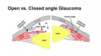 CÁC LOẠI BỆNH TĂNG NHÃN ÁP VÀ CÁCH ĐIỀU TRỊ