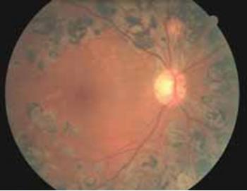 CƯỜM KHÔ KÈM BỆNH ĐÁI THÁO ĐƯỜNG VÀ TĂNG HUYẾT ÁP: CÓ NÊN PHẪU THUẬT...