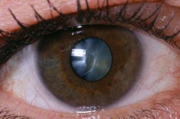 ĐỤC THỦY TINH THỂ (CƯỜM KHÔ)