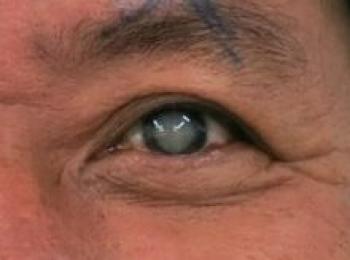 KHI NÀO THÌ NGHI NGỜ BỊ BỆNH CƯỜM KHÔ?